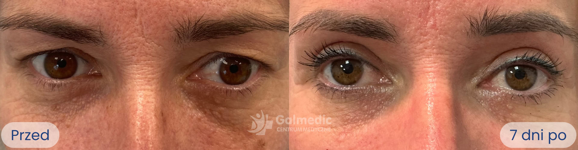 plastyka powiek górnych