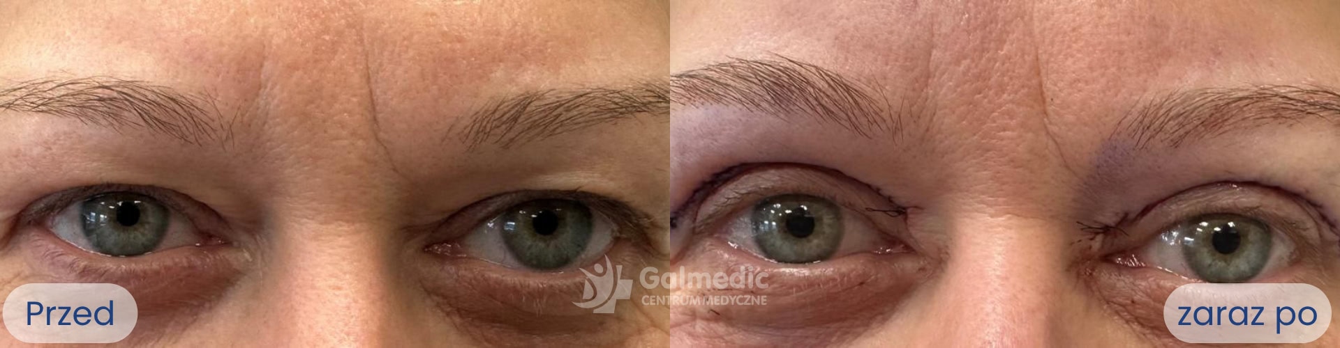 plastyka powiek górnych