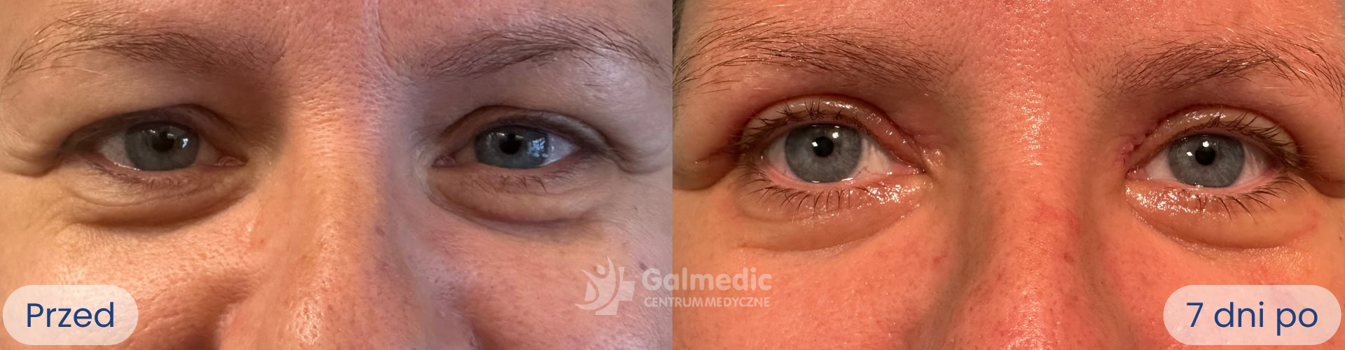 plastyka powiek górnych