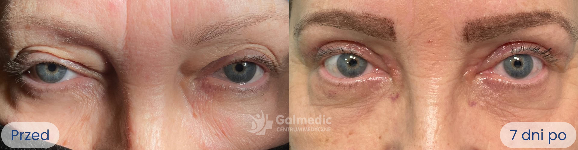 plastyka powiek górnych