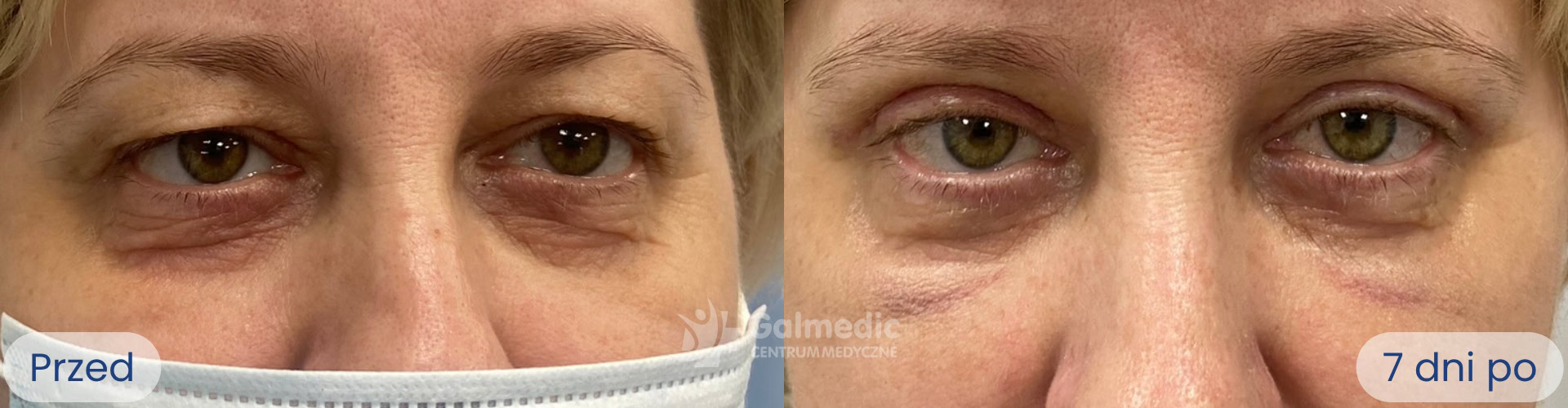 plastyka powiek górnych