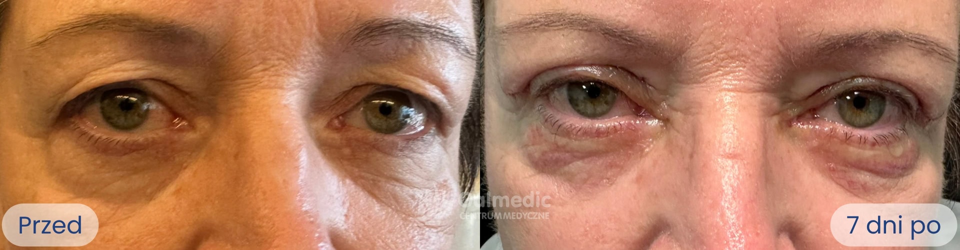 plastyka powiek górnych