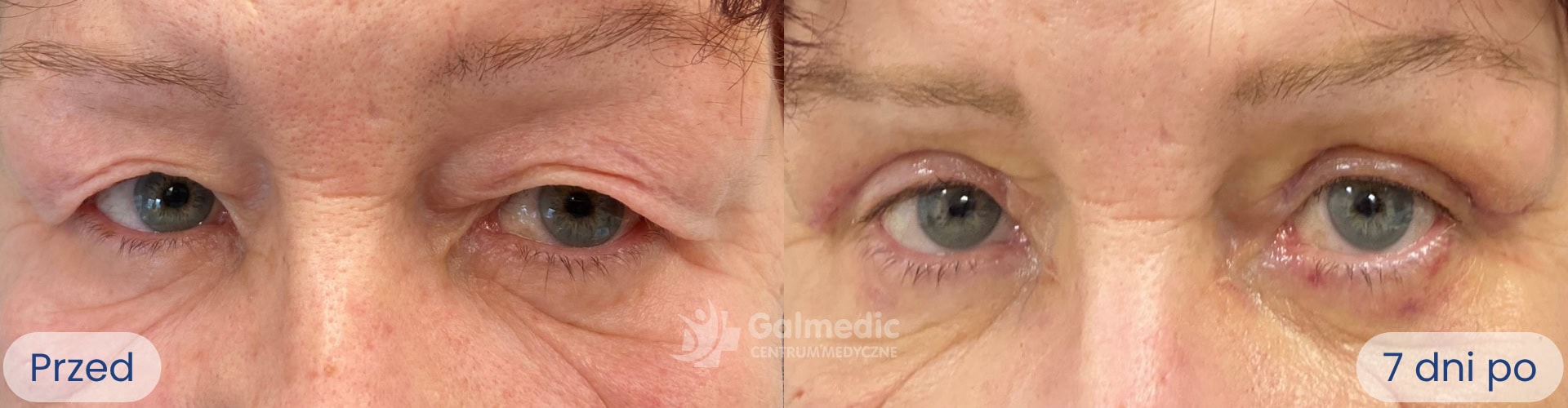 plastyka powiek górnych