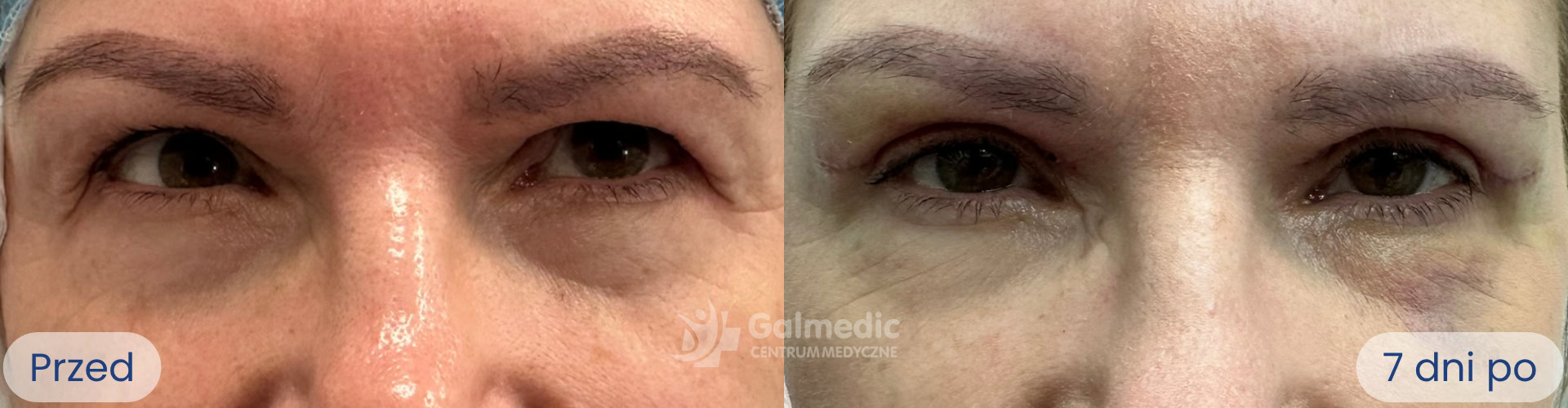 plastyka powiek górnych